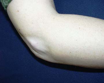 steroid injected for tennis elbow