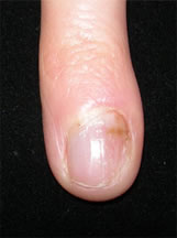 Paronychia before treatment