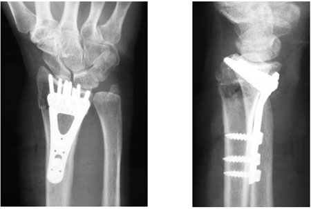 plate and screws inserted at surgery to hold the bones in the proper place