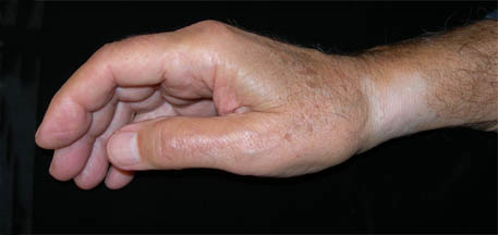 Steroid injections side effects arthritis