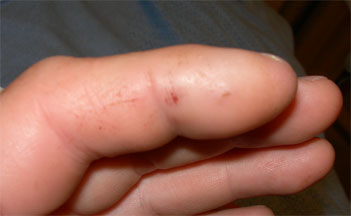 Snake bite close-up