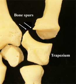 Osteoarthritis