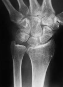 Wrist -normal