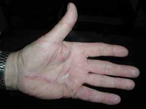 Duputyren's Incision