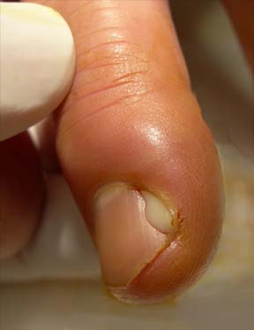 close-up of the fingertip with pus