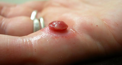 Hypertrophic Granulation Tissue