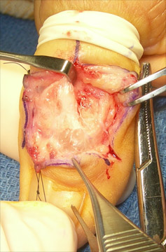 mucous cyst