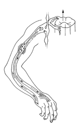 Complex Regional Pain Syndrome