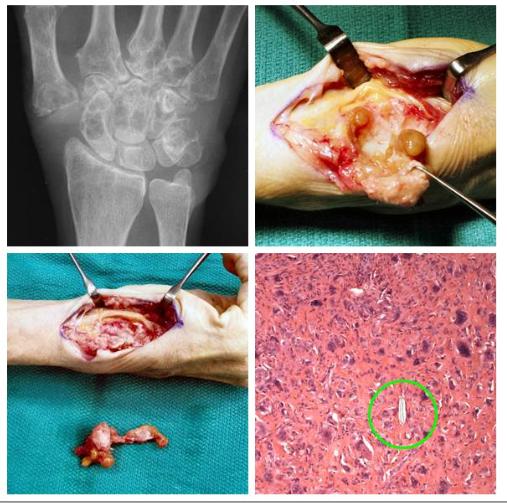 silicone synovitis