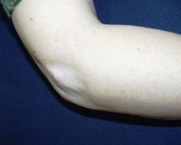 Steroid injection in elbow