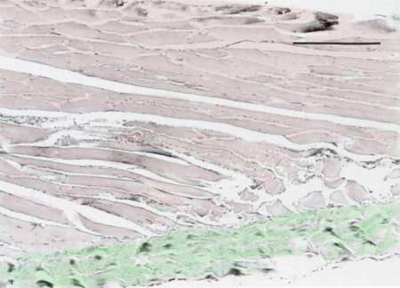 Tennis Elbow Histology 1