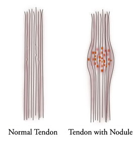 Tendon: Normal and w/nodule