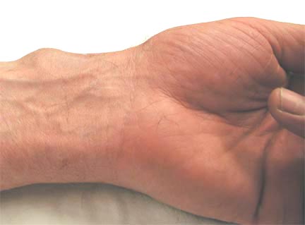 The volar wrist ganglion is near but not at the wrist crease.