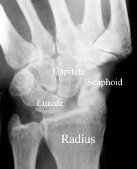 Severe Osteoarthritis