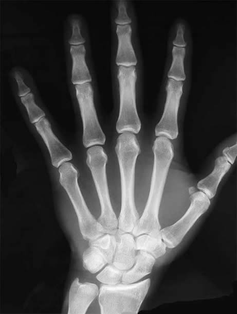 XRay of normal hand