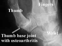 Osteoarthritis of the thumb