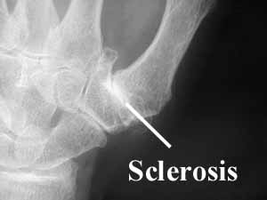 Very promising evidence that LSJL induced longitudinal bone growth in