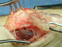 What happens after surgical removal of a ganglion cyst on the middle little finger joint?