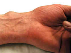 wrist ganglion