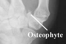 Osteophyte 1