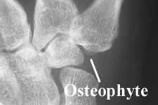 Osteophyte 2