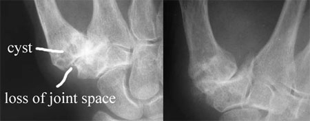 Cyst and loss of joint space