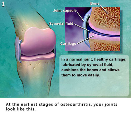 széles körben elterjedt osteoarthritis