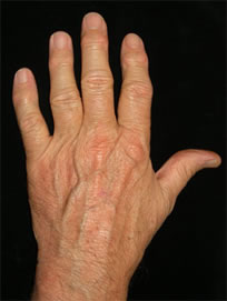 Hand 1 w/Osteoarthritis