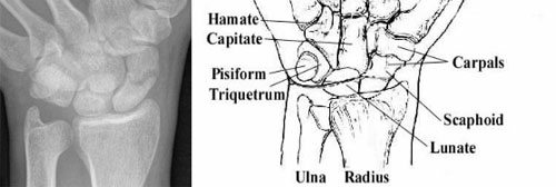 scaphoid fracture