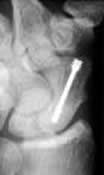 Scaphoid Screw