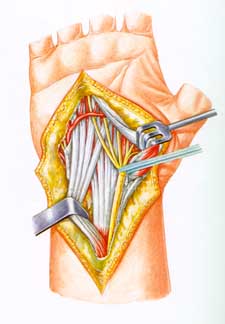 Tendons in Wrist