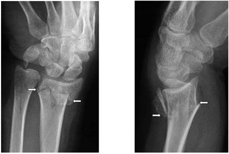 What is a buckle fracture of the wrist?