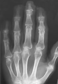 xray of Hand 1